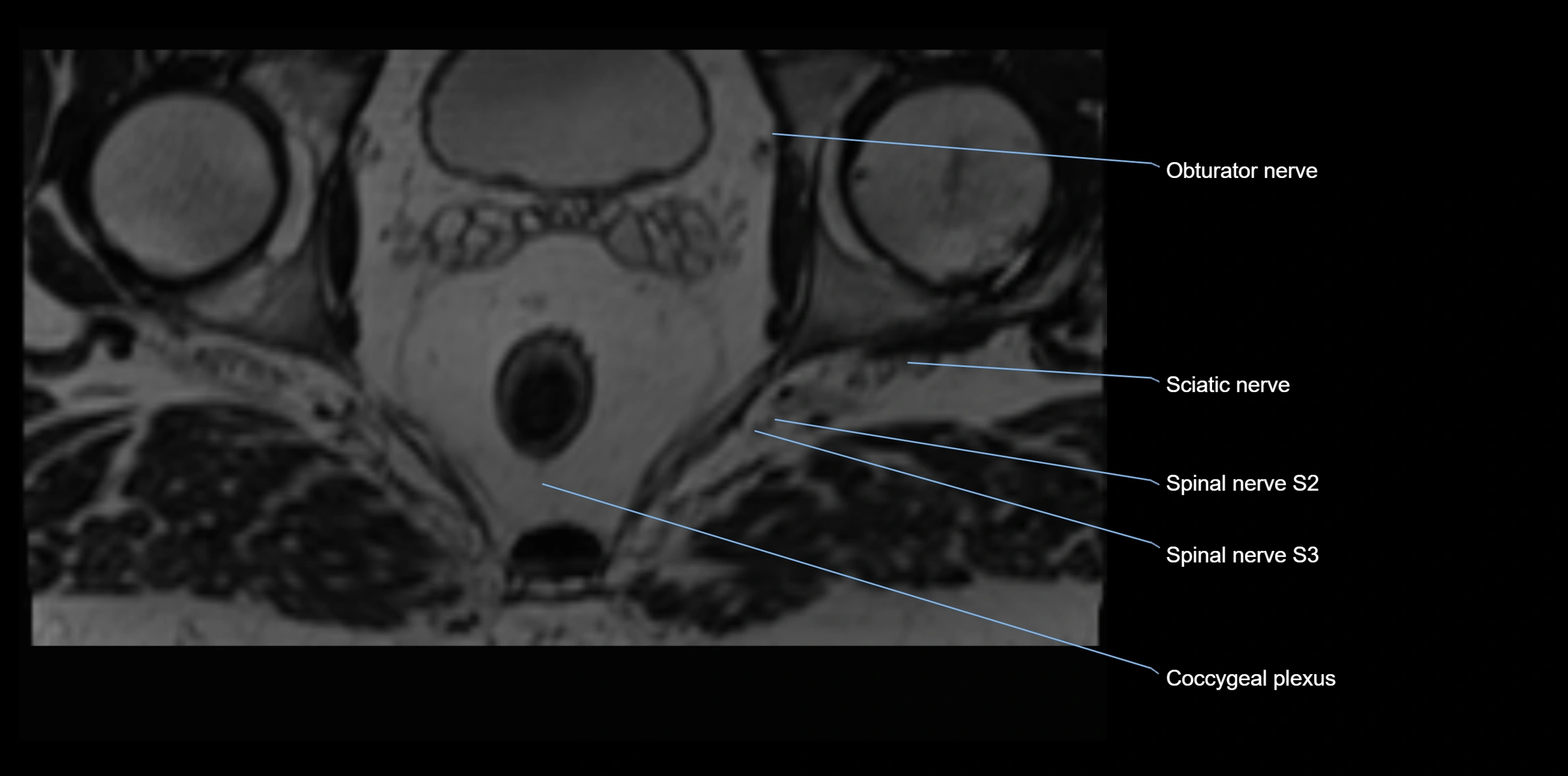MR lumbosacral plexus axial cross sectional anatomy 3T  radiology  image-img-1008001-00119.webp